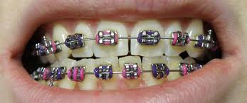 Braces & Orthodontics