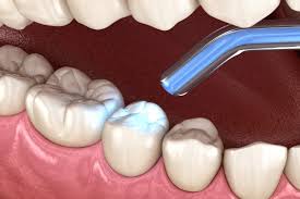 Fillings & Restorations