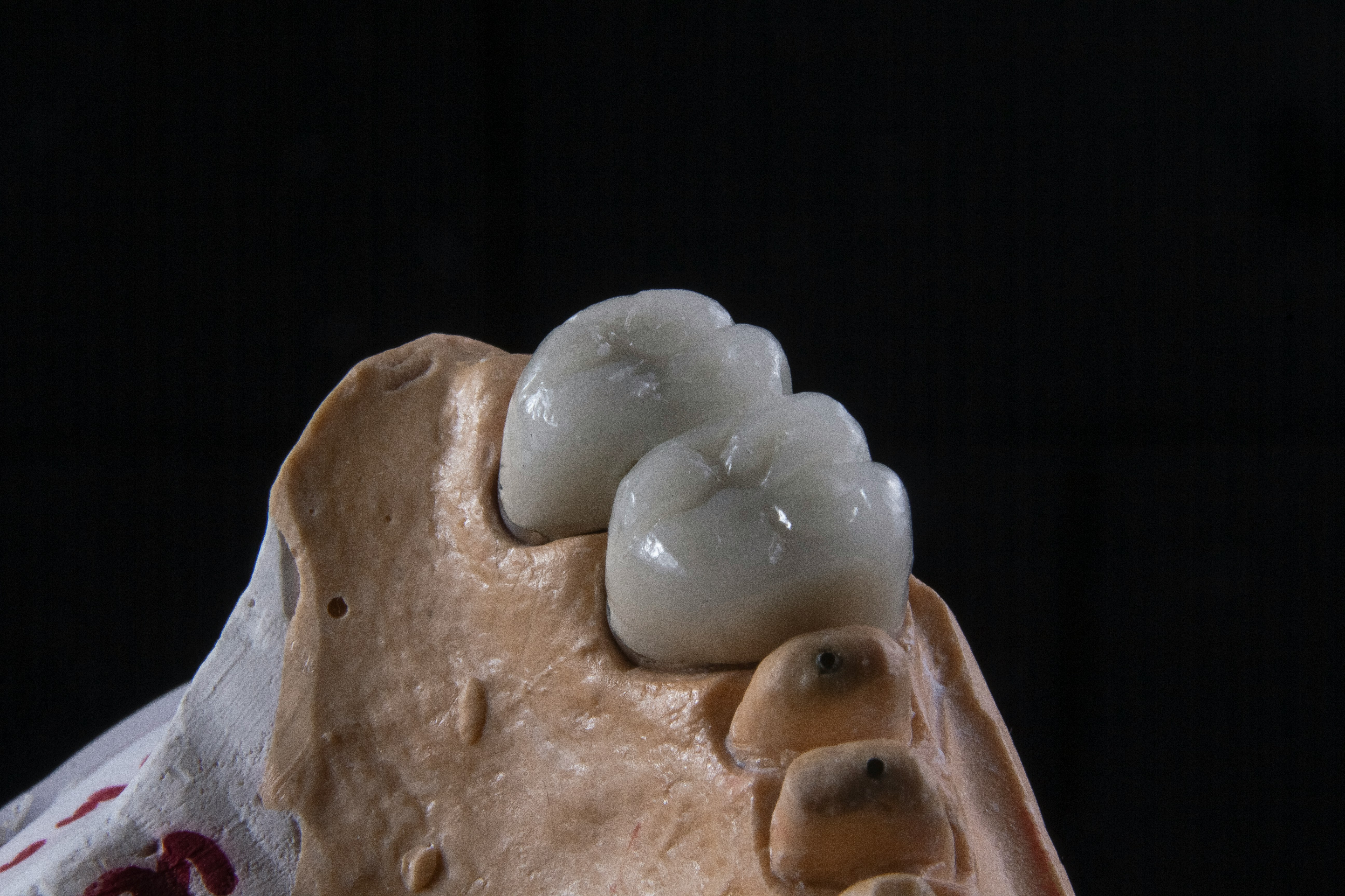 Basal Implants